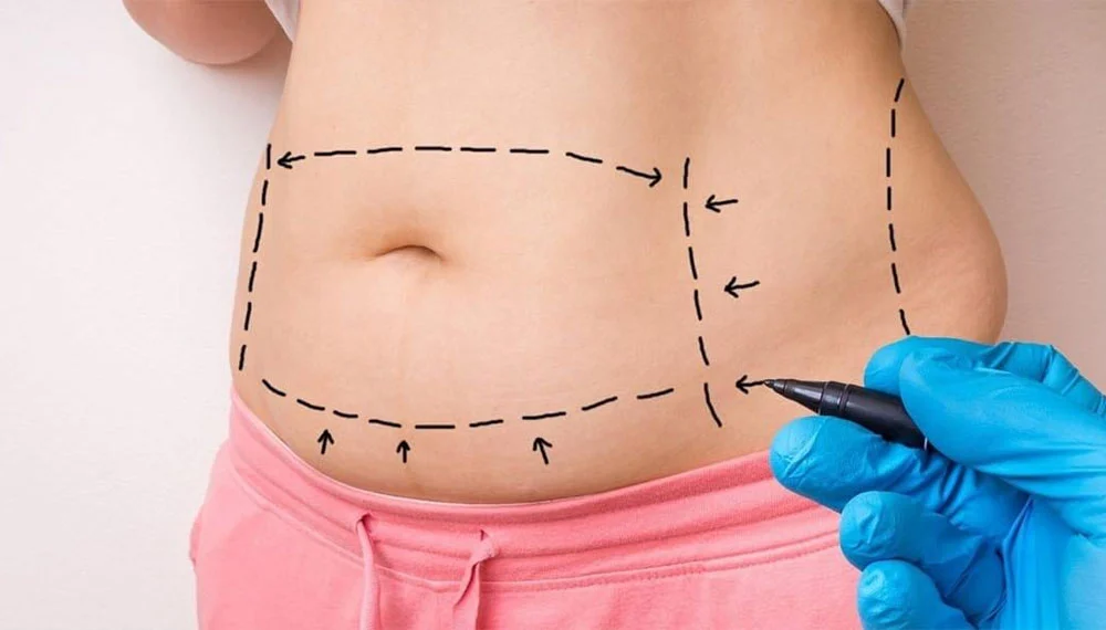 Tummy Tuck in Dubai
