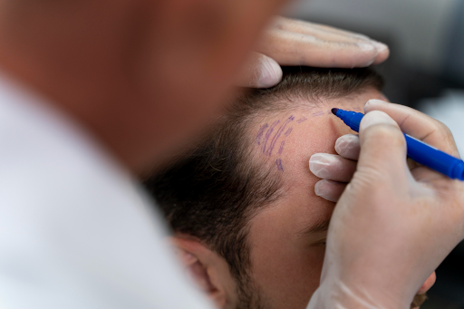 FUT Hair Transplant